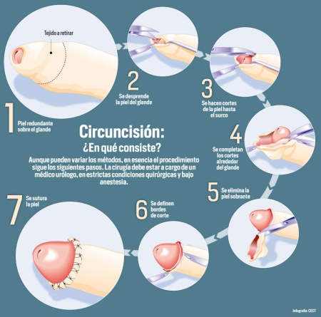 circuncision